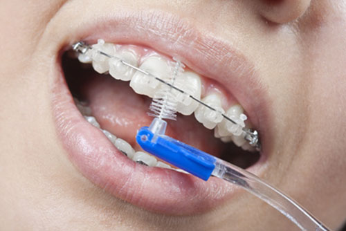 Brushing your teeth with braces